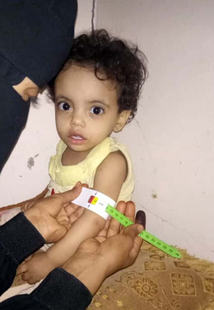 International Medical Corps Community Healthcare Volunteer Naseem Al-Arawe diagnoses two-year-old resident of Al-Kharba village with severe acute malnutrition.