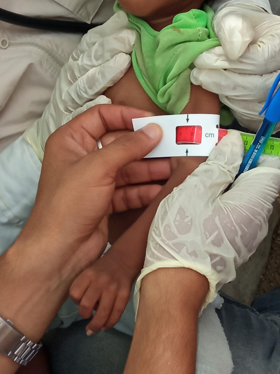 A mobile team member measures a child for malnutrition. The red color shows on the tape when the arm size is too thin for a healthy child.